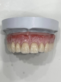 Răng sứ thẩm mỹ Cercon HCT