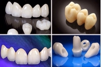 Răng sứ Ziconia và Cercon HT