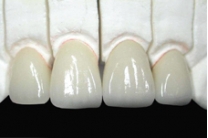 RĂNG SỨ CERCON BASE