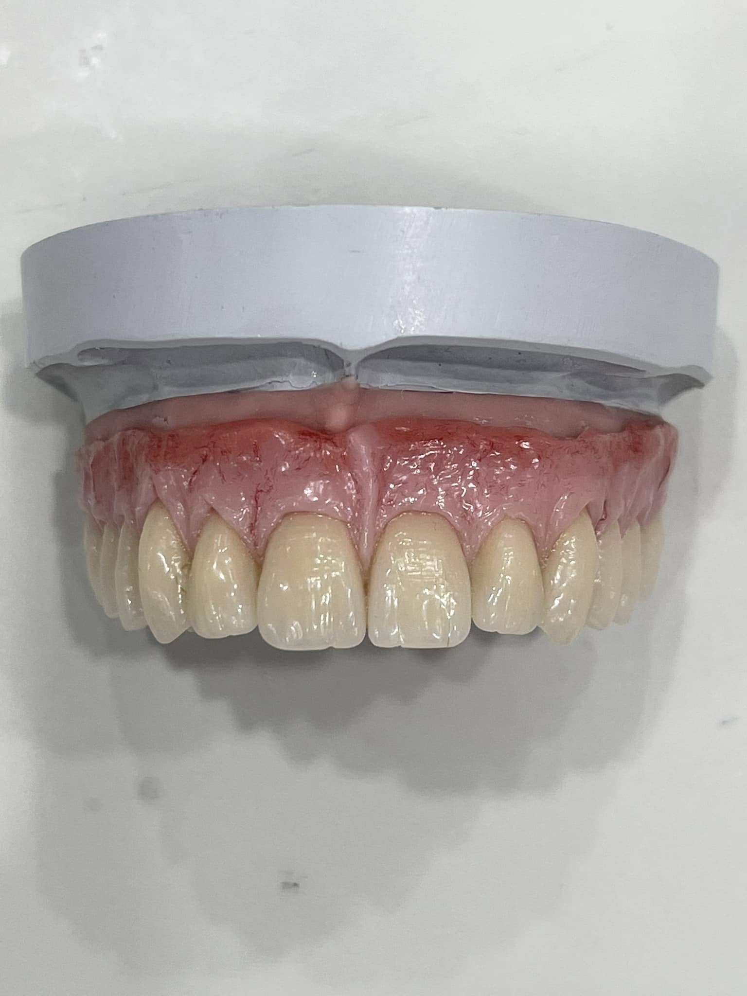 Răng sứ thẩm mỹ Cercon HCT