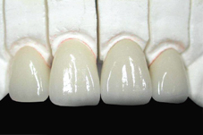 RĂNG SỨ CERCON BASE